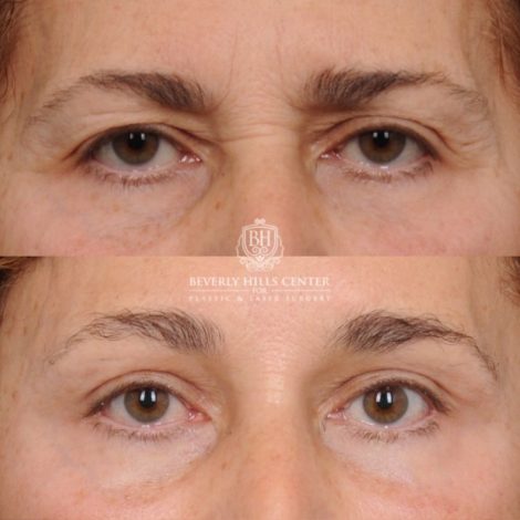 Beverly Hills Center Female Patient Before and After AuraLyft, Temporal Brow Reset, Upper Blepharoplasty, Fat Grafting, Ptosis Repair