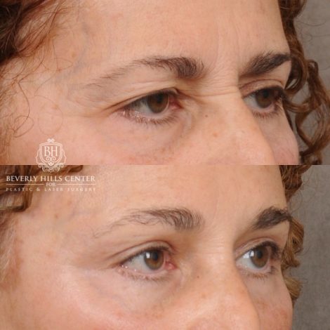 Beverly Hills Center Female Patient Before and After AuraLyft, Temporal Brow Reset, Upper Blepharoplasty, Fat Grafting, Ptosis Repair