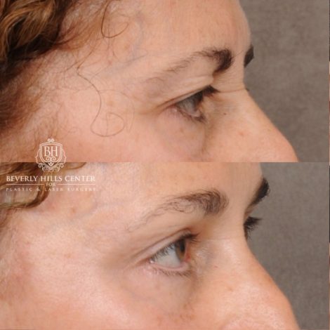 Beverly Hills Center Female Patient Before and After AuraLyft, Temporal Brow Reset, Upper Blepharoplasty, Fat Grafting, Ptosis Repair
