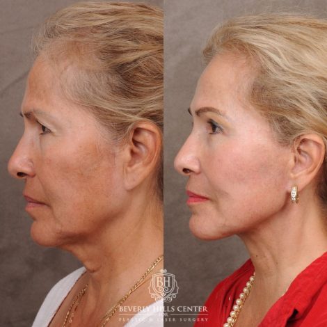 Beverly Hills Center Female Patient Before and After AuraLyft™, Temporal Brow Reset, Upper Blepharoplasty, Ptosis Repair, Fat Grafting