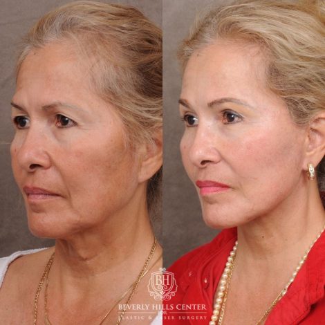 Beverly Hills Center Female Patient Before and After AuraLyft™, Temporal Brow Reset, Upper Blepharoplasty, Ptosis Repair, Fat Grafting