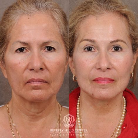 Beverly Hills Center Female Patient Before and After AuraLyft™, Temporal Brow Reset, Upper Blepharoplasty, Ptosis Repair, Fat Grafting