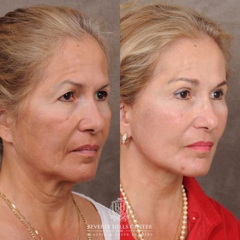 Beverly Hills Center Female Patient Before and After AuraLyft™, Temporal Brow Reset, Upper Blepharoplasty, Ptosis Repair, Fat Grafting