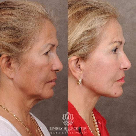 Beverly Hills Center Female Patient Before and After AuraLyft™, Temporal Brow Reset, Upper Blepharoplasty, Ptosis Repair, Fat Grafting