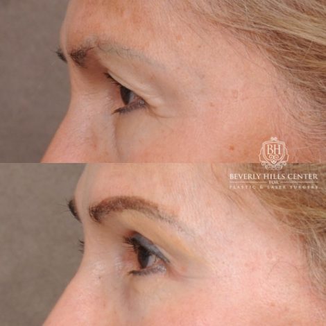 Beverly Hills Center Female Patient Before and After AuraLyft™, Temporal Brow Reset, Upper Blepharoplasty, Ptosis Repair, Fat Grafting