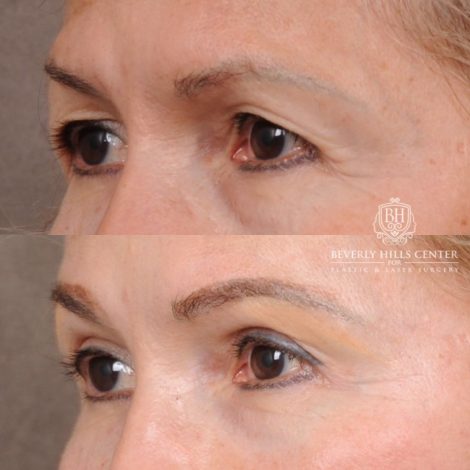 Beverly Hills Center Female Patient Before and After AuraLyft™, Temporal Brow Reset, Upper Blepharoplasty, Ptosis Repair, Fat Grafting