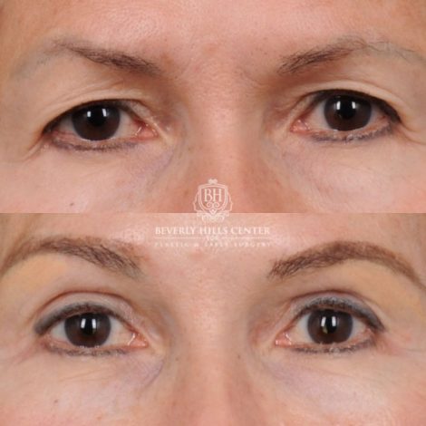 Beverly Hills Center Female Patient Before and After AuraLyft™, Temporal Brow Reset, Upper Blepharoplasty, Ptosis Repair, Fat Grafting