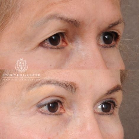 Beverly Hills Center Female Patient Before and After AuraLyft™, Temporal Brow Reset, Upper Blepharoplasty, Ptosis Repair, Fat Grafting