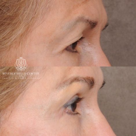 Beverly Hills Center Female Patient Before and After AuraLyft™, Temporal Brow Reset, Upper Blepharoplasty, Ptosis Repair, Fat Grafting