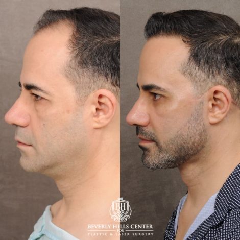 Beverly Hills Center Male Patient Before and After AuraLyft™, Cupid Lift®, Temporal Brow Reset, Lower Blepharoplasty, Ptosis Repair