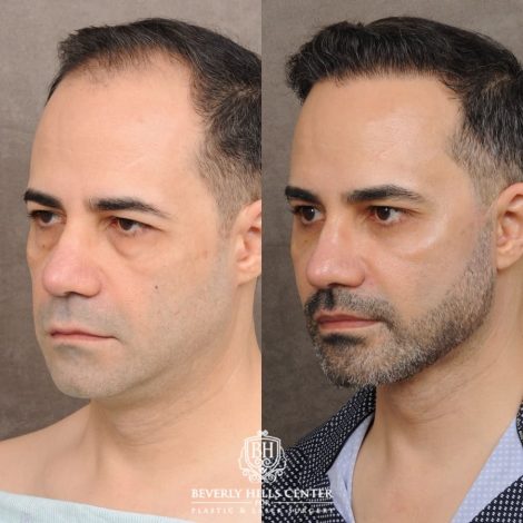 Beverly Hills Center Male Patient Before and After AuraLyft™, Cupid Lift®, Temporal Brow Reset, Lower Blepharoplasty, Ptosis Repair