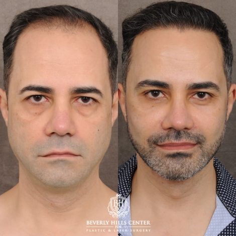 Beverly Hills Center Male Patient Before and After AuraLyft™, Cupid Lift®, Temporal Brow Reset, Lower Blepharoplasty, Ptosis Repair
