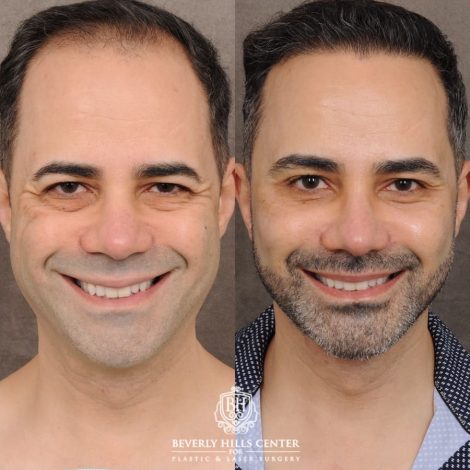Beverly Hills Center Male Patient Before and After AuraLyft™, Cupid Lift®, Temporal Brow Reset, Lower Blepharoplasty, Ptosis Repair