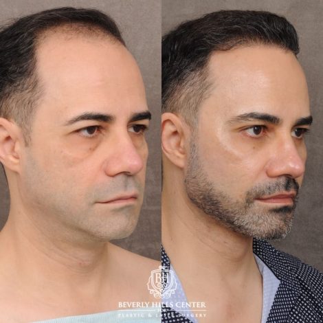 Beverly Hills Center Male Patient Before and After AuraLyft™, Cupid Lift®, Temporal Brow Reset, Lower Blepharoplasty, Ptosis Repair