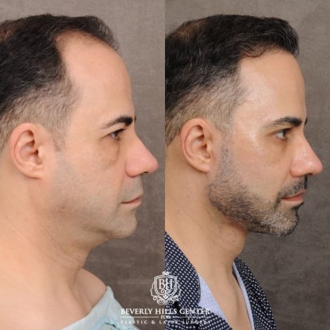 Beverly Hills Center Male Patient Before and After AuraLyft™, Cupid Lift®, Temporal Brow Reset, Lower Blepharoplasty, Ptosis Repair