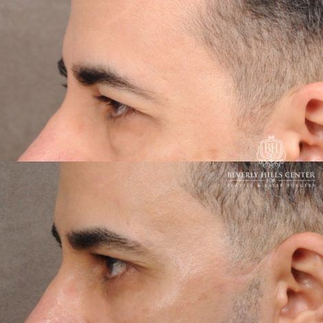 Beverly Hills Center Male Patient Before and After AuraLyft™, Cupid Lift®, Temporal Brow Reset, Lower Blepharoplasty, Ptosis Repair