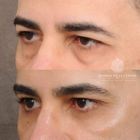 Beverly Hills Center Male Patient Before and After AuraLyft™, Cupid Lift®, Temporal Brow Reset, Lower Blepharoplasty, Ptosis Repair