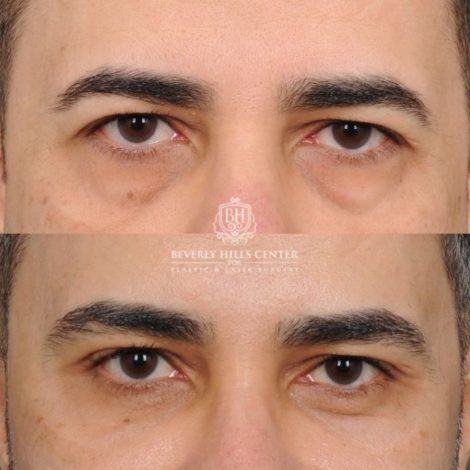 Beverly Hills Center Male Patient Before and After AuraLyft™, Cupid Lift®, Temporal Brow Reset, Lower Blepharoplasty, Ptosis Repair