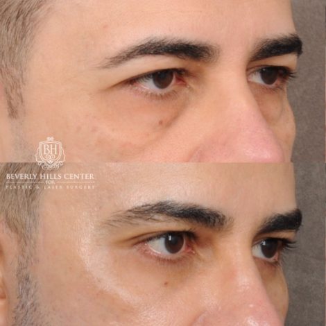 Beverly Hills Center Male Patient Before and After AuraLyft™, Cupid Lift®, Temporal Brow Reset, Lower Blepharoplasty, Ptosis Repair