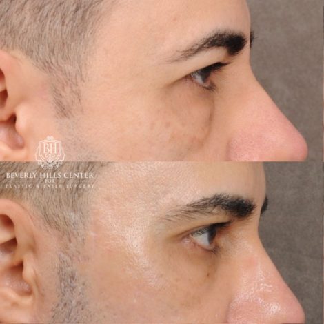 Beverly Hills Center Male Patient Before and After AuraLyft™, Cupid Lift®, Temporal Brow Reset, Lower Blepharoplasty, Ptosis Repair