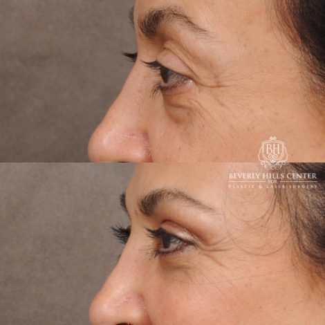 Beverly Hills Center Female Patient Before and After Upper & Lower Blepharoplasty, Minor Fat Grafting & Repositioning