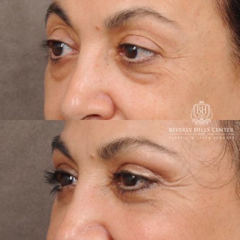 Beverly Hills Center Female Patient Before and After Upper & Lower Blepharoplasty, Minor Fat Grafting & Repositioning