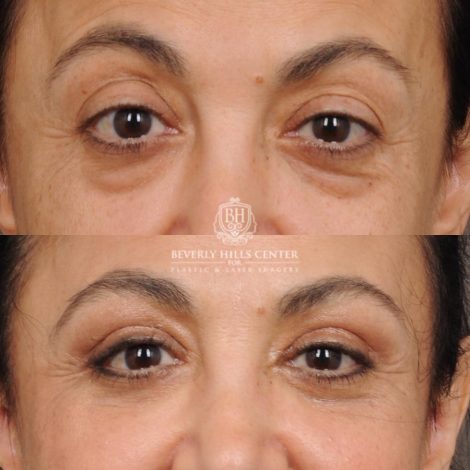 Beverly Hills Center Female Patient Before and After Upper & Lower Blepharoplasty, Minor Fat Grafting & Repositioning