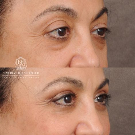 Beverly Hills Center Female Patient Before and After Upper & Lower Blepharoplasty, Minor Fat Grafting & Repositioning