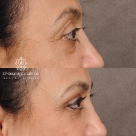 Beverly Hills Center Female Patient Before and After Upper & Lower Blepharoplasty, Minor Fat Grafting & Repositioning