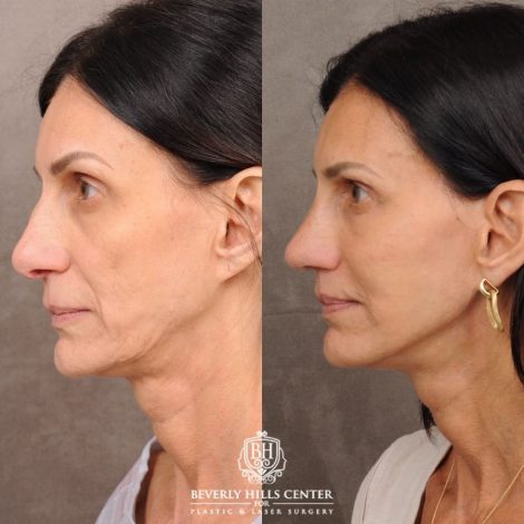 Beverly Hills Center Female Patient Before and After AuraLyft, Upper Blepharoplasty, Fat Grafting & PRP