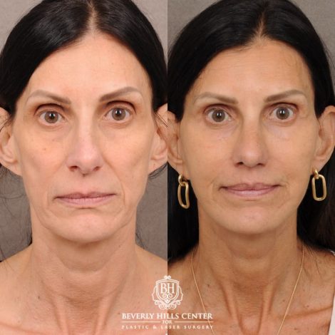 Beverly Hills Center Female Patient Before and After AuraLyft, Upper Blepharoplasty, Fat Grafting & PRP