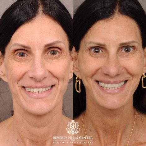 Beverly Hills Center Female Patient Before and After AuraLyft, Upper Blepharoplasty, Fat Grafting & PRP