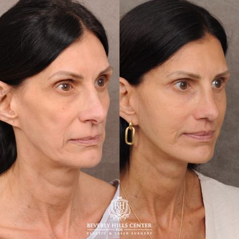 Beverly Hills Center Female Patient Before and After AuraLyft, Upper Blepharoplasty, Fat Grafting & PRP