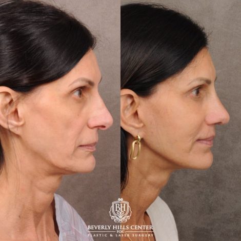 Beverly Hills Center Female Patient Before and After AuraLyft, Upper Blepharoplasty, Fat Grafting & PRP