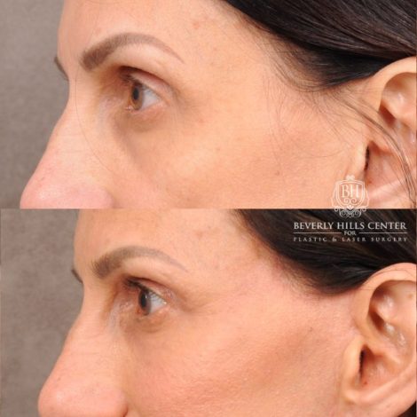 Beverly Hills Center Female Patient Before and After AuraLyft, Upper Blepharoplasty, Fat Grafting & PRP
