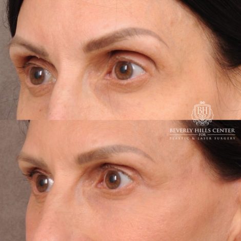 Beverly Hills Center Female Patient Before and After AuraLyft, Upper Blepharoplasty, Fat Grafting & PRP