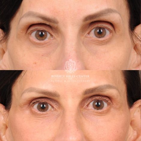 Beverly Hills Center Female Patient Before and After AuraLyft, Upper Blepharoplasty, Fat Grafting & PRP