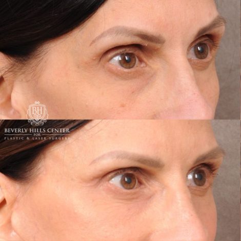 Beverly Hills Center Female Patient Before and After AuraLyft, Upper Blepharoplasty, Fat Grafting & PRP