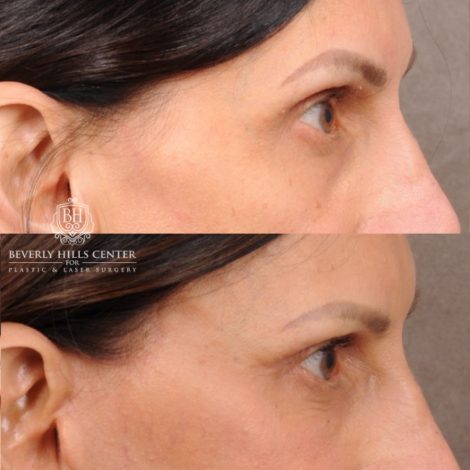 Beverly Hills Center Female Patient Before and After AuraLyft, Upper Blepharoplasty, Fat Grafting & PRP
