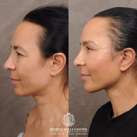 Beverly Hills Center Female Patient Before and After AuraLyft™, Temporal Brow Reset, Lower Blepharoplasty with Fat Repositioning, Ptosis Repair, Fat Grafting