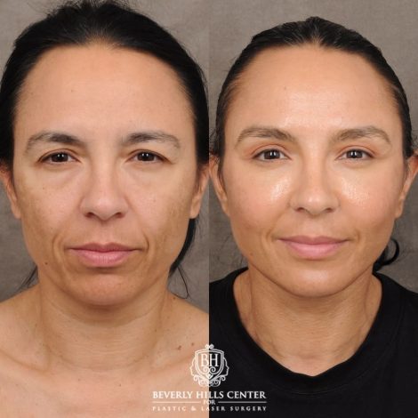 Side-by-side comparison of a woman’s face before (left) and after (right) a cosmetic procedure, showing smoother skin, reduced wrinkles, and an overall more refreshed appearance. Beverly Hills Center logo at the bottom.