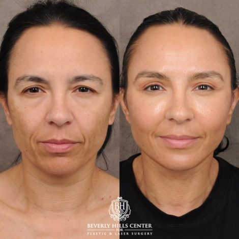 Beverly Hills Center Female Patient Before and After AuraLyft™, Temporal Brow Reset, Lower Blepharoplasty with Fat Repositioning, Ptosis Repair, Fat Grafting