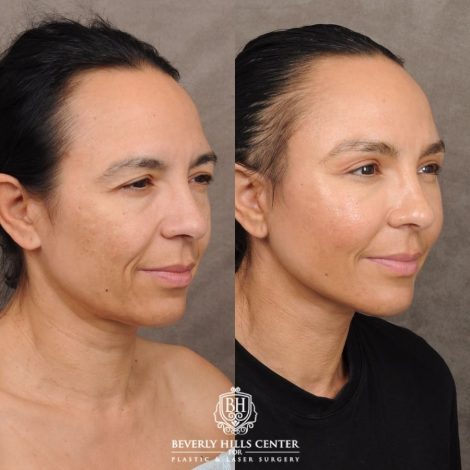 Beverly Hills Center Female Patient Before and After AuraLyft™, Temporal Brow Reset, Lower Blepharoplasty with Fat Repositioning, Ptosis Repair, Fat Grafting