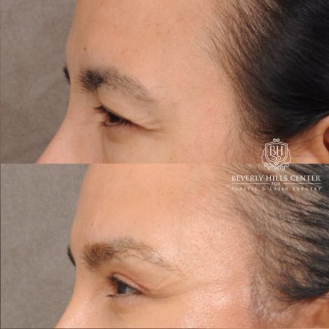Beverly Hills Center Female Patient Before and After AuraLyft™, Temporal Brow Reset, Lower Blepharoplasty with Fat Repositioning, Ptosis Repair, Fat Grafting
