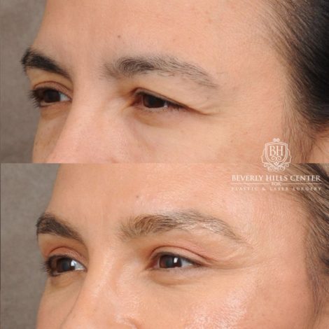 Beverly Hills Center Female Patient Before and After AuraLyft™, Temporal Brow Reset, Lower Blepharoplasty with Fat Repositioning, Ptosis Repair, Fat Grafting