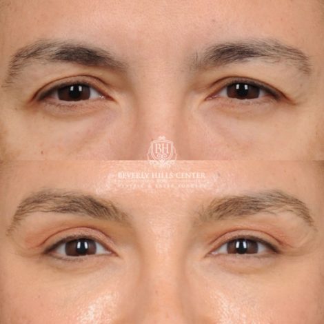 Beverly Hills Center Female Patient Before and After AuraLyft™, Temporal Brow Reset, Lower Blepharoplasty with Fat Repositioning, Ptosis Repair, Fat Grafting