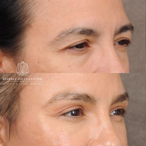 Beverly Hills Center Female Patient Before and After AuraLyft™, Temporal Brow Reset, Lower Blepharoplasty with Fat Repositioning, Ptosis Repair, Fat Grafting