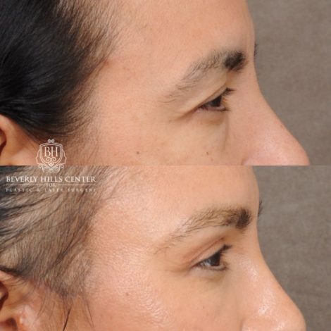 Beverly Hills Center Female Patient Before and After AuraLyft™, Temporal Brow Reset, Lower Blepharoplasty with Fat Repositioning, Ptosis Repair, Fat Grafting