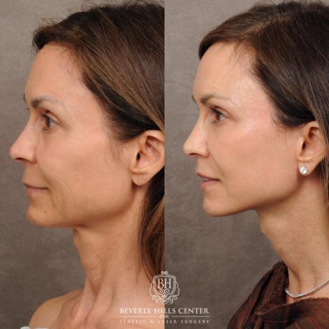 Beverly Hills Center Female Patient Before and After AuraLyft, Cupid Lift®, Upper Blepharoplasty, Nanofat