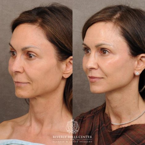 Beverly Hills Center Female Patient Before and After AuraLyft, Cupid Lift®, Upper Blepharoplasty, Nanofat